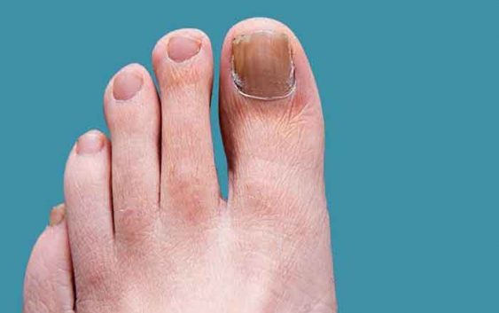 Everything you need to know about nail fungus