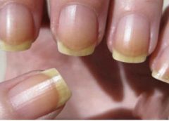 What are the grandmother’s remedies against yellow nails?