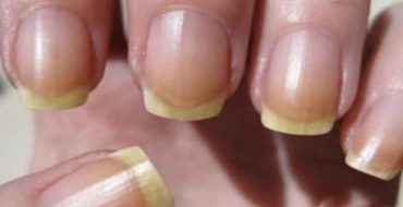 How to overcome the yellow nails?