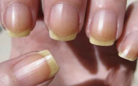 How to overcome the yellow nails?