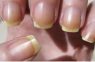 How to overcome the yellow nails?